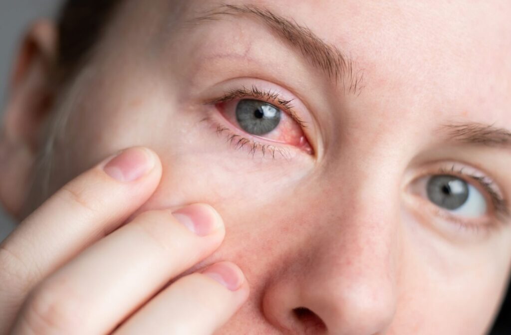 A close-up of a person’s eye showing redness and irritation in the inner corner, with their fingers gently pulling down the lower eyelid to reveal the affected area.